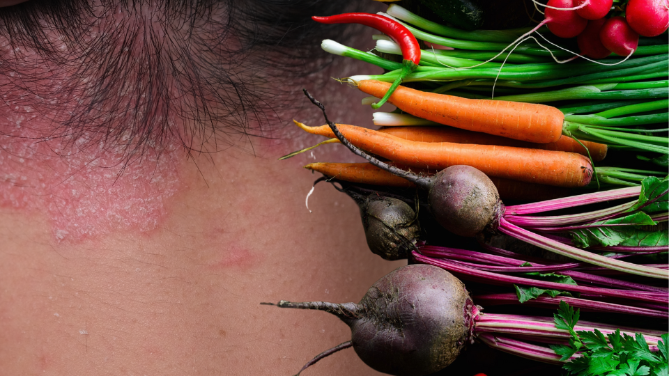 Como a alimentação pode ajudar no controle da psoríase
